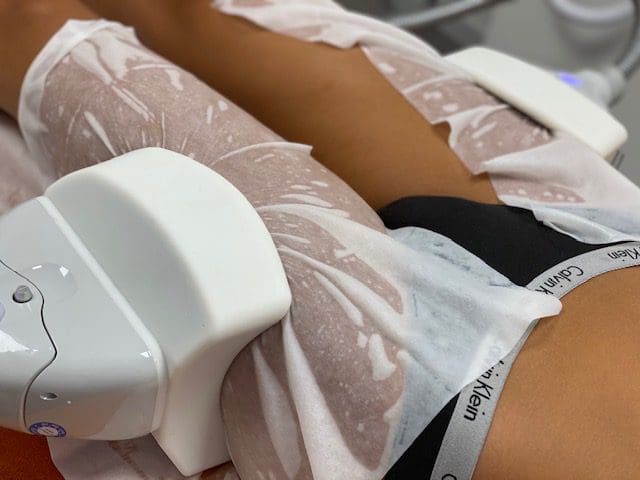 cryolipolyse cuisses silice